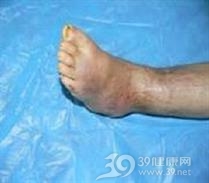 遗传性感觉神经病