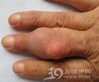 遗传性高尿酸血症