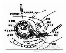 遗传性凝血因子Ⅺ缺乏