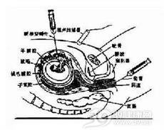 遗传性凝血因子ⅩⅢ缺乏