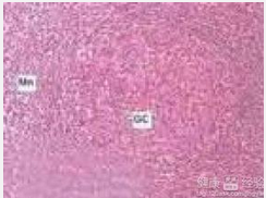 原发免疫性疾病相关的淋巴增殖性疾病