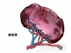 原发性脾淋巴瘤
