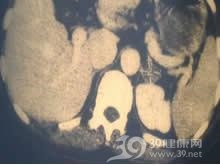 原发性醛固酮增多症