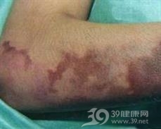 原发性血小板减少性紫癜