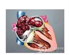 原发性心脏肿瘤