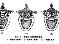 硬脊膜脓肿