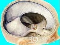 硬脑膜外和硬脑膜下脓肿
