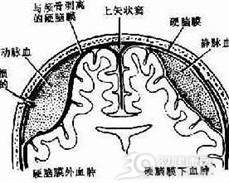 硬脑膜下脓肿
