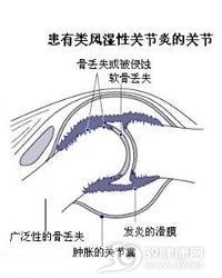 幼年型类风湿性关节炎