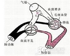 药物性呼吸衰竭