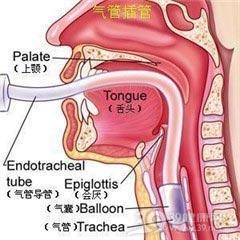 医源性气管及主支气管损伤