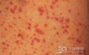 严重肝病引起获得性凝血因子异常