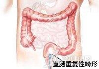 直肠重复畸形