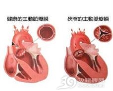 主动脉瓣膜部狭窄