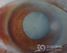 中毒性白内障