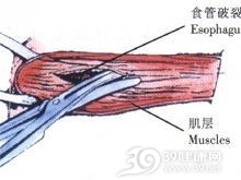 自发性食管破裂