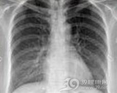 纵隔气肿