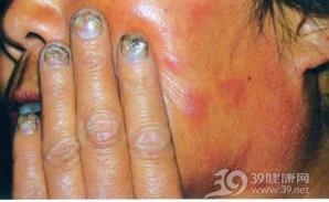 真菌中毒症