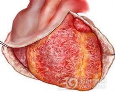 肿瘤性心包炎