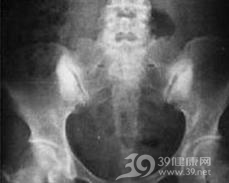致密性骨发育障碍
