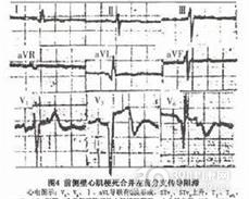 左前分支传导阻滞