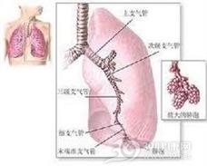 支气管发育不全