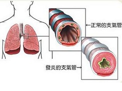 支气管炎