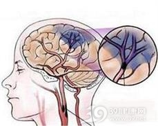 中青年脑梗死