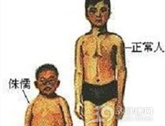 侏儒症
