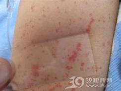 自身红细胞过敏性紫癜