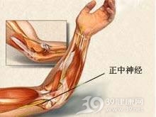 正中神经损伤